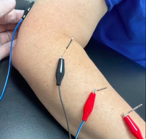 dry needling